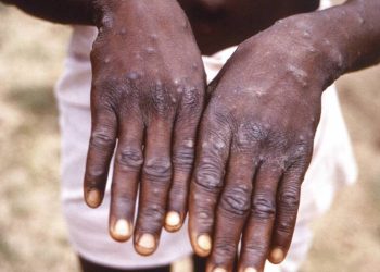 Santé: plus de 5.236 cas de variole du singe enregistrés entre janvier et juin 2023 dont 229 décès en RDC