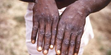 Santé: plus de 5.236 cas de variole du singe enregistrés entre janvier et juin 2023 dont 229 décès en RDC