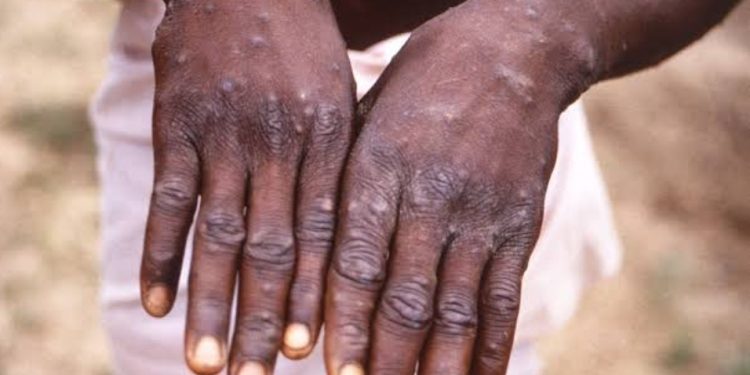 Urgent : Un cas du virus de singe confirmé à l’Hôpital général de référence de Kinshasa (Officiel)