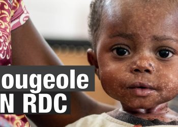 RDC: 5.799 décès enregistrés de la rougeole depuis 2023 (ministère de la santé publique)