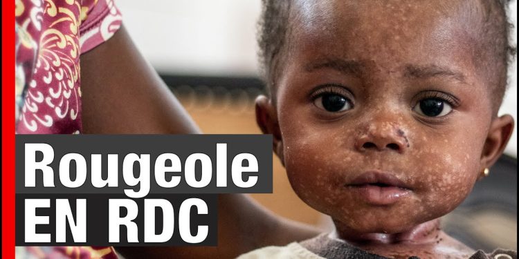 RDC: 5.799 décès enregistrés de la rougeole depuis 2023 (ministère de la santé publique)