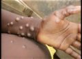 Sud-Kivu: Plus de 582 cas de Monkeypox enregistrés dans 17 zones de santé depuis le mois de janvier jusqu’à ce jour