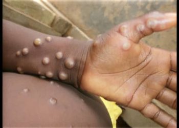 Sud-Kivu: Plus de 582 cas de Monkeypox enregistrés dans 17 zones de santé depuis le mois de janvier jusqu’à ce jour