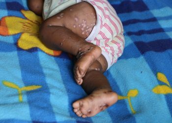 RDC-Santé : Sur 8600 cas de Monkeypox enregistrés, au moins 410 personnes sont décédées en mi-juin 2024