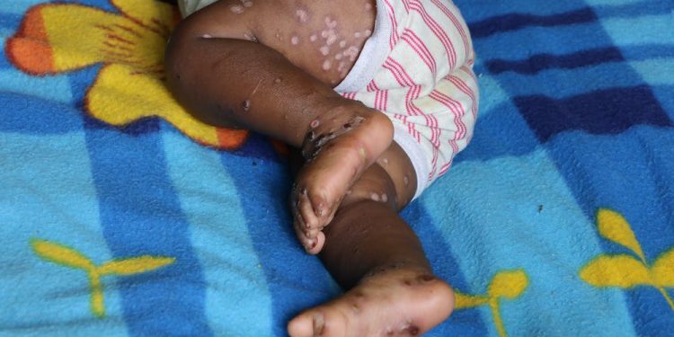 RDC-Santé : Sur 8600 cas de Monkeypox enregistrés, au moins 410 personnes sont décédées en mi-juin 2024