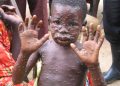 Variole du singe : La RDC a enregistré 11.166 cas suspects de cette maladie dont 450 décès, soit une létalité de 4% (Le ministère de la santé)