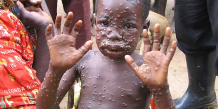 Variole du singe : La RDC a enregistré 11.166 cas suspects de cette maladie dont 450 décès, soit une létalité de 4% (Le ministère de la santé)