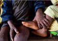 MonkeyPox en RDC : Plus de 12.300 cas suspects enregistrés de janvier à la mi-juillet 2024 (Médecins Sans Frontières)