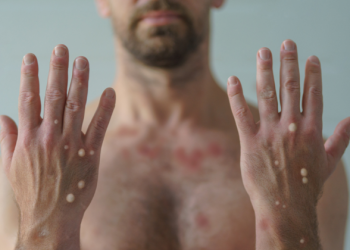 Variole du singe: L’OIM lance un appel de fonds d’un montant de 18,5 millions de dollars pour une aide d’urgence aux personnes touchées par l’épidémie (document)