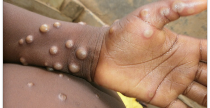 Santé : Voici comment se transmet l’épidémie de MONKEYPOX (Médecins Sans Frontières)