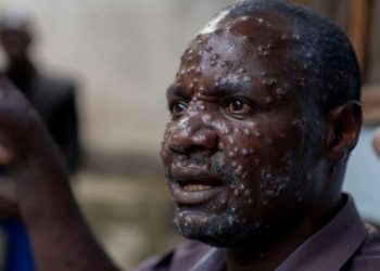MONKEYPOX en RDC : La province du Sud-Kivu dépasse la barre de 5.000 cas enregistrés