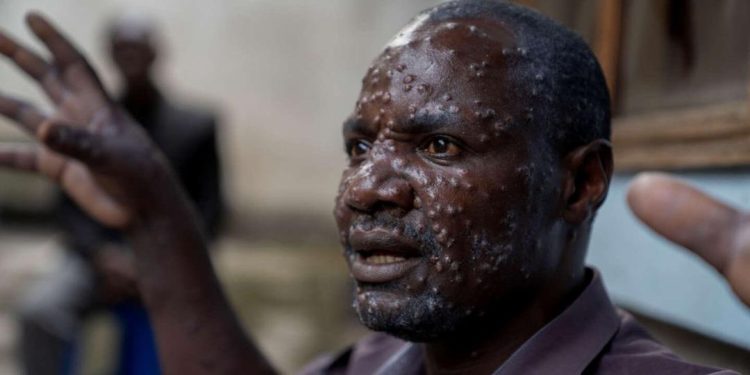 MONKEYPOX en RDC : La province du Sud-Kivu dépasse la barre de 5.000 cas enregistrés