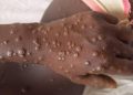 MONKEYPOX en RDC : La province du Kasaï enregistre 108 cas de cette épidémie et 9 décès