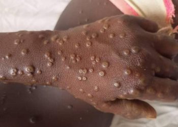 MONKEYPOX en RDC : La province du Kasaï enregistre 108 cas de cette épidémie et 9 décès