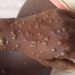 MONKEYPOX en RDC : La province du Kasaï enregistre 108 cas de cette épidémie et 9 décès