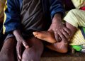 KONGO-CENTRAL : quatre cas suspects de variole du singe(MPOX) identifiés à KASANGULU