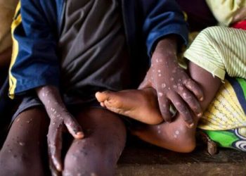 KONGO-CENTRAL : quatre cas suspects de variole du singe(MPOX) identifiés à KASANGULU