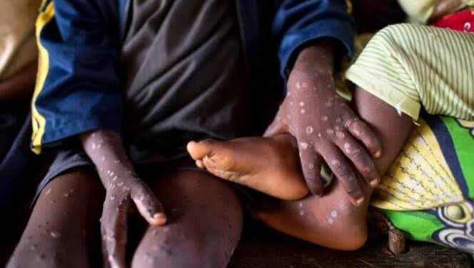 KONGO-CENTRAL : quatre cas suspects de variole du singe(MPOX) identifiés à KASANGULU