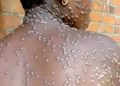 Lomami : un premier cas positif de Monkey Pox enregistré sur 24 cas suspects détectés