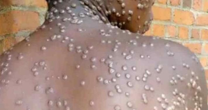 Lomami : un premier cas positif de Monkey Pox enregistré sur 24 cas suspects détectés