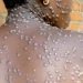 Lomami : un premier cas positif de Monkey Pox enregistré sur 24 cas suspects détectés