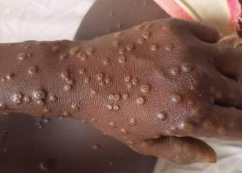 RDC : La campagne de vaccination contre la variole du singe se déroule du 02 au 11 octobre 2024 (Conseil des ministres)