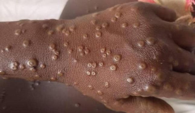 RDC : La campagne de vaccination contre la variole du singe se déroule du 02 au 11 octobre 2024 (Conseil des ministres)