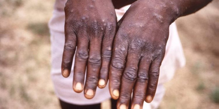 MAÏ-NDOMBE: Plus de 24 nouveaux cas de Mpox ont été enregistrés à la 37ème semaine épidémiologique, dont un décès (division provinciale de la santé)