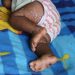 NORD-KIVU : Premier cas positif de MPOX identifié à KYAVINYONGE (Beni)