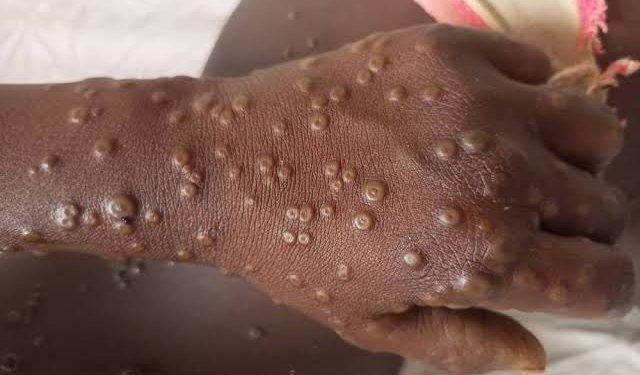Sant-RDC : Prévu pour le 02 octobre, le début de la campagne de vaccination contre la variole du singe est repoussé au 5 octobre 2024 (Officiel)
