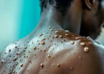 Santé : La province du Haut-Katanga est finalement touchée par l’épidémie de MONKEYPOX avec deux cas confirmés