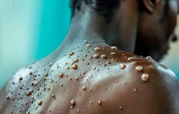 Santé : La province du Haut-Katanga est finalement touchée par l’épidémie de MONKEYPOX avec deux cas confirmés