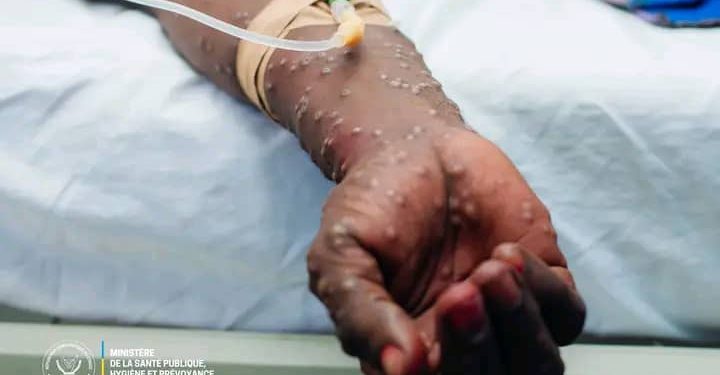 RDC-Santé: 1 049 décès de MONKEYPOX enregistrés en République démocratique du Congo depuis le début de l’année 2024 (le ministre de la Santé)