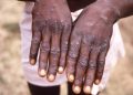 RDC : Plus de 478 cas de MONKEYPOX enregistrés au cours de la 46eme semaine épidémiologique (Ministère de la santé)
