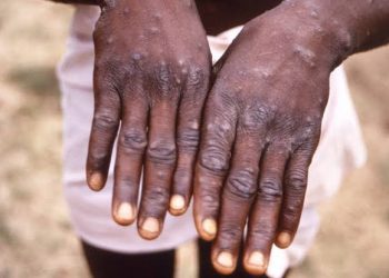 RDC : Plus de 478 cas de MONKEYPOX enregistrés au cours de la 46eme semaine épidémiologique (Ministère de la santé)
