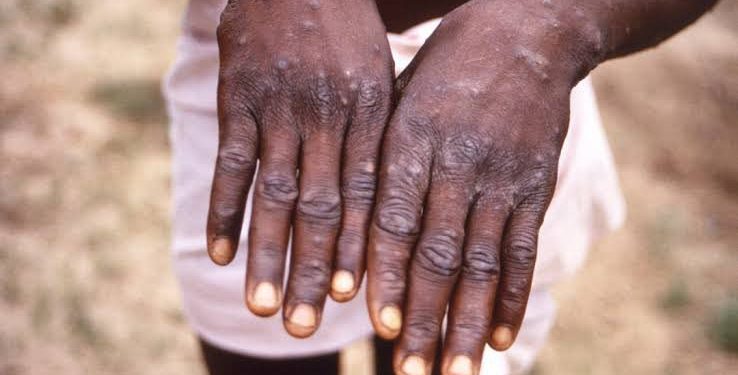 RDC : Plus de 478 cas de MONKEYPOX enregistrés au cours de la 46eme semaine épidémiologique (Ministère de la santé)