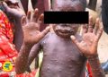 RDC : La province du Sud-Kivu a enregistré plus de 14.500 cas de l’épidémie de MONKEYPOX depuis janvier 2024 (Ministère de santé)