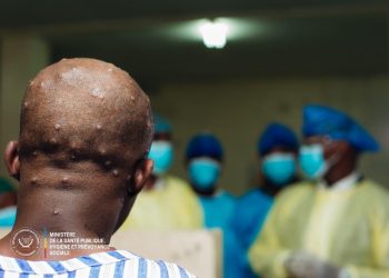 RDC : 604 nouveaux cas de Monkeypox enregistrés à la 49ème semaine épidémiologique (Ministère de la Santé publique)