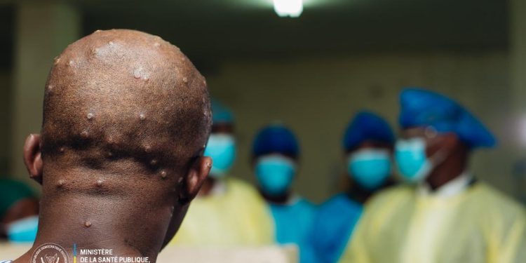 RDC : 604 nouveaux cas de Monkeypox enregistrés à la 49ème semaine épidémiologique (Ministère de la Santé publique)