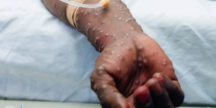 Épidémie de MPOX en RDC : Le Royaume-Uni augmente son soutien aux besoins humanitaires avec un financement de 4,4 millions de livres sterling