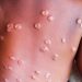 Santé : La RDC enregistre plus de 800 cas suspects de Mpox en 6 jours (ministère de la santé)