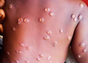 Santé : Plus de 1200 décès dus au Monkeypox enregistrés en 2024 en RDC (Rapport)