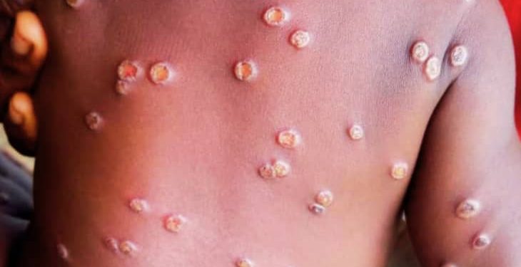 Santé : Plus de 1200 décès dus au Monkeypox enregistrés en 2024 en RDC (Rapport)