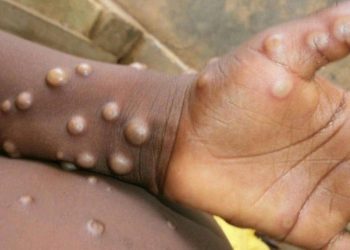 Épidémie de Monkey Pox : La RDC enregistre 20 décès et 512 cas confirmés pour la première semaine épidémiologique de 2025 (Document)