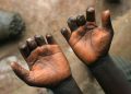 Alarme sanitaire à Moba : 250 nouveaux cas de lèpre enregistrés en 2024 (Document)