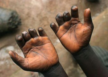 Alarme sanitaire à Moba : 250 nouveaux cas de lèpre enregistrés en 2024 (Document)