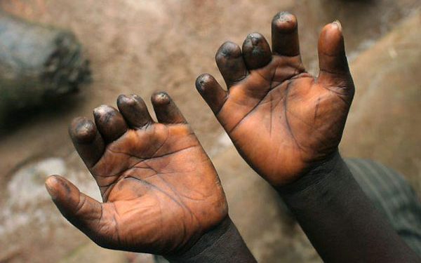 Alarme sanitaire à Moba : 250 nouveaux cas de lèpre enregistrés en 2024 (Document)