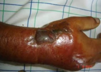 RDC : Une nouvelle épidémie d’Anthrax déclarée dans la province du Nord-Kivu (Document)