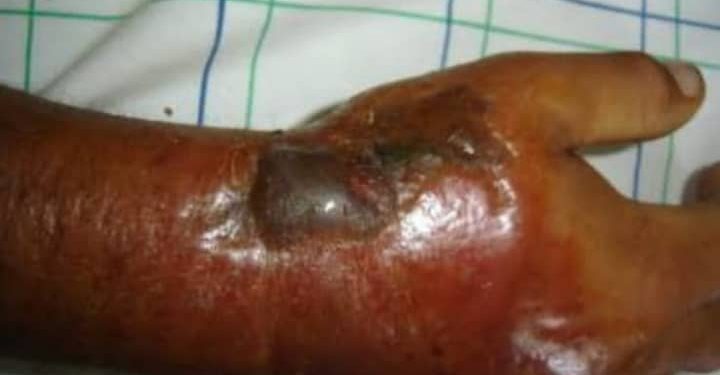 RDC : Une nouvelle épidémie d’Anthrax déclarée dans la province du Nord-Kivu (Document)