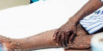 RDC : 1,5 Million de Doses du Vaccin LC16m8 Attenues le 29 mai prochain à Kinshasa pour Lutter Contre le Mpox